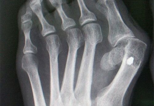 X -ray