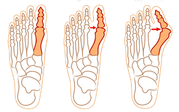 Hallux valgus deformity
