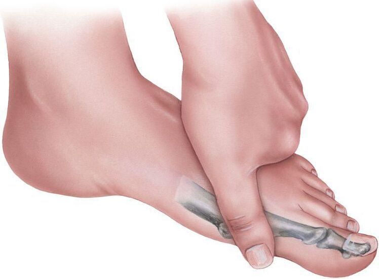 Foot pain due to plano-valgus deformity