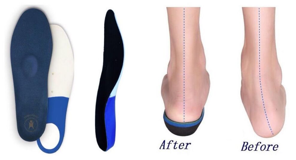 Orthotic insoles for plano-valgus foot deformity