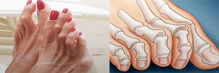 hammertoe deformity