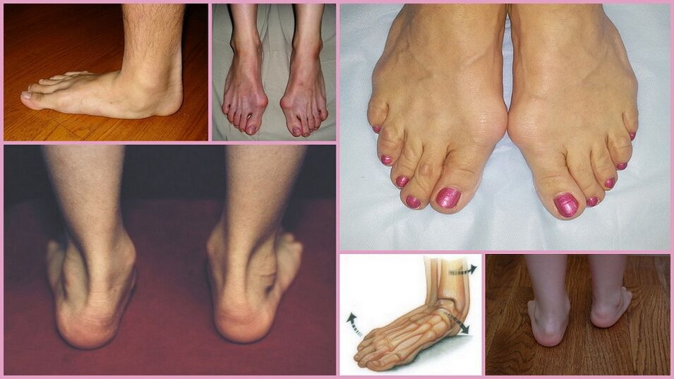 Symptoms of crooked toes in adults
