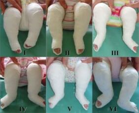 Plastering procedures, each procedure changes the position of the foot