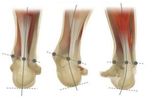 The foot is normal, the heel bone is deviated and varus