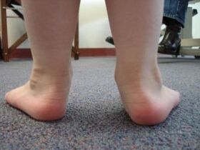 Valgus foot deformity in children