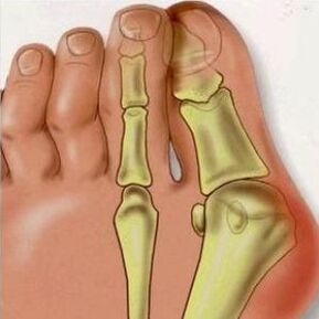 Reasons for Valgus