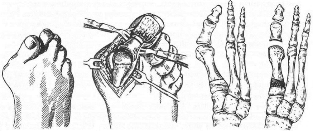 Treatment types