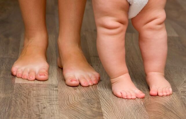 Deforming Valgus of the foot in children