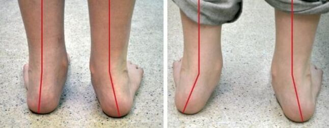 Valgus legs
