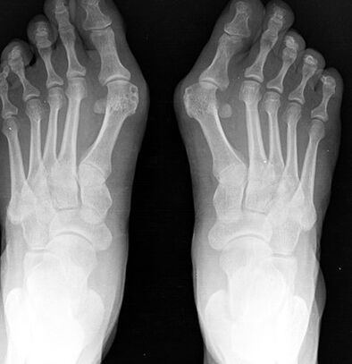 X -ray of the foot